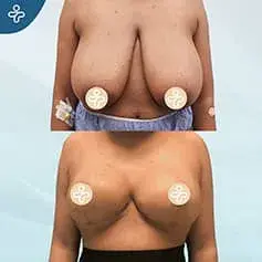 XXXL Extended Breast Uplift Before and After