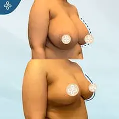 Inverted T Breast Reduction Before and After