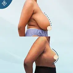 XXXL Extended Breast Reduction