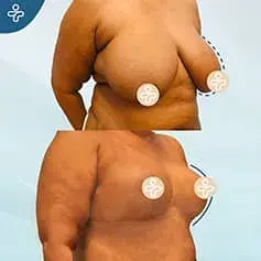 XL Reduction Before & After