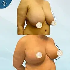 Breast Reduction + Uplift Before and After