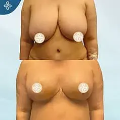 Breast Reduction + Uplift Before and After