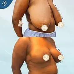 +XXXL Extended Breast Reduction