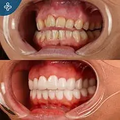 Tooth Extraction + Crowns Before & After