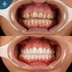 Tooth Extraction + Crowns Before & After