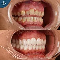 Tooth Extraction + Crowns Before & After