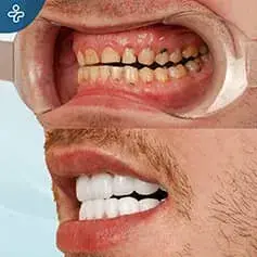 Strong Teeth Degradation + Crowns