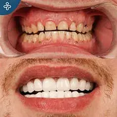 Strong Teeth Degradation + Crowns