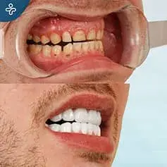 Strong Teeth Degradation + Crowns