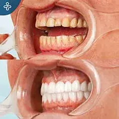 On-Tooth Dental Crowns Before and After
