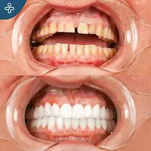 On-Tooth Dental Crowns Before and After