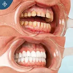 On-Tooth Dental Crowns Before and After
