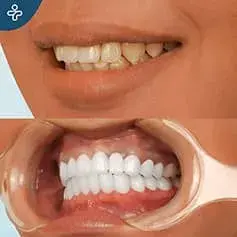 X-Tra White Dental Crowns Before/After