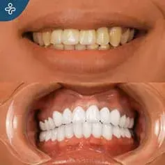 X-Tra White Dental Crowns Before/After