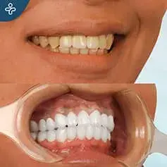 X-Tra White Dental Crowns Before/After
