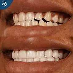 Full Mouth Dental Crowns Before and After in Turkey