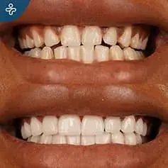 Full Mouth Dental Crowns Before and After in Turkey