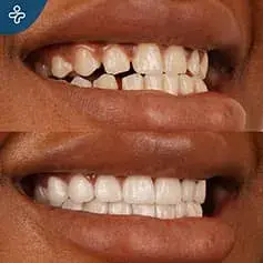 Full Mouth Dental Crowns Before and After in Turkey