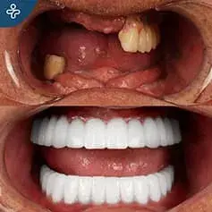 Full Mouth Dental Implants Turkey Before and After