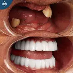 Full Mouth Dental Implants Turkey Before and After