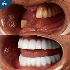 Full Mouth Dental Implants Turkey Before and After
