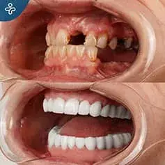Complete Hollywood Smile Restauration