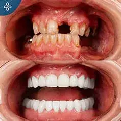 Complete Hollywood Smile Restauration