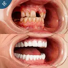 Complete Hollywood Smile Restauration