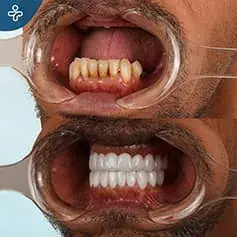 Upper Jaw Makeover