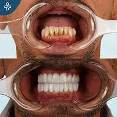 Upper Jaw Makeover