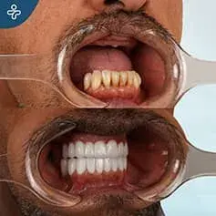 Upper Jaw Makeover