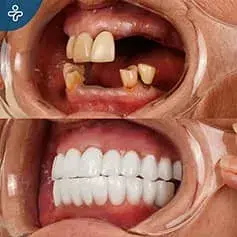 Swiss Dental Implants in Turkey Before and After