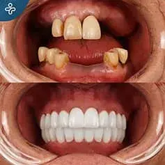Swiss Dental Implants in Turkey Before and After