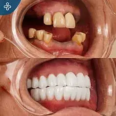 Swiss Dental Implants in Turkey Before and After