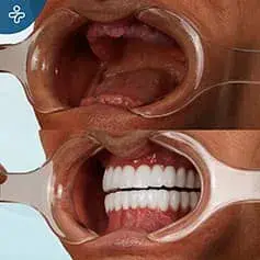 Gingival Disease Before and After Implants