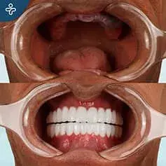 Gingival Disease Before and After Implants