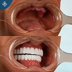 Gingival Disease Before and After Implants