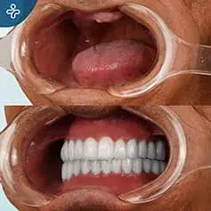 Full Mouth Makeover