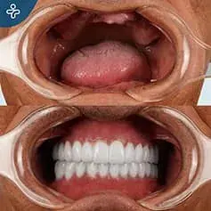 Full Mouth Makeover