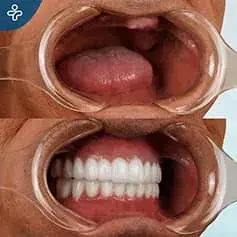 Full Mouth Makeover