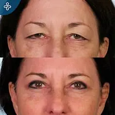 before-after-eyelid-surgery-2-1