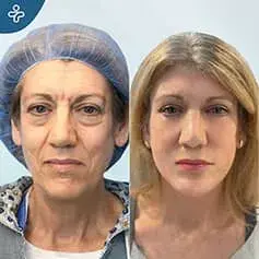 Extended High SMAS Facelift Before and After