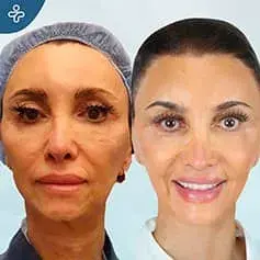 Mini Facelift Before and After