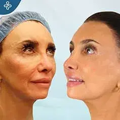 Mini Facelift Before and After