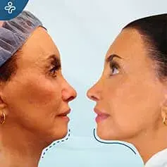 Mini Facelift Before and After