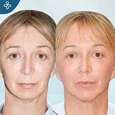 Fat Transfer Before and After
