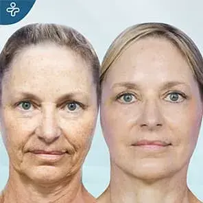 Face Fat Transfer Before and After