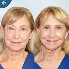 Full Facelift, Neck lift and Face Fat Transfer Before & After