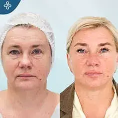 Eye Bags Fat Transfer to Face Before and After