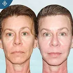 Skin Folds Fat Transfer Before and After